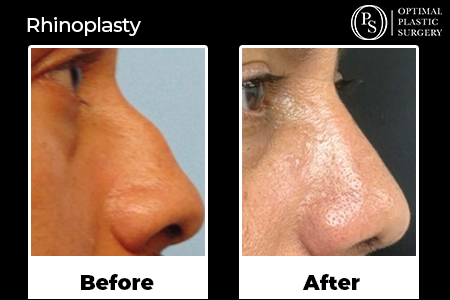 Before and after Rhinoplasty patient, surgery by Dr. Bivens