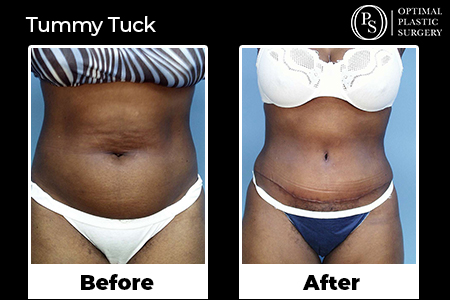 Before and after treatment of a tummy tuck procedure, surgery by Optimal Plastic Surgery