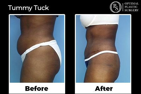 Before and after profile of a tummy tuck patient, surgery by Dr. Bivens