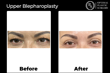 Before and after Eyelid Surgery patient, surgery by Dr. Bivens