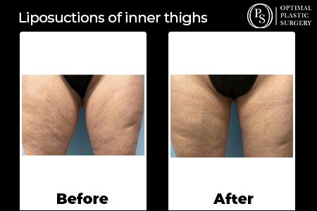 Before and after liposuction of the inner thigh area, surgery by Optimal Plastic Surgery