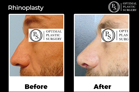 Before and after Nose Surgery by Optimal Plastic Surgery