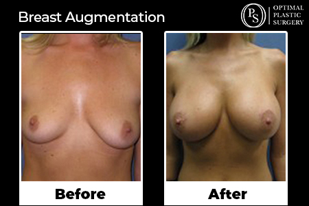 Before and After Breast Augmentation Orange County Optimal Plastic Surgery