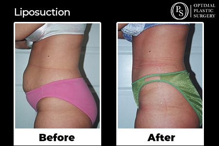 Before and after liposuction, surgery by Optimal Plastic Surgery