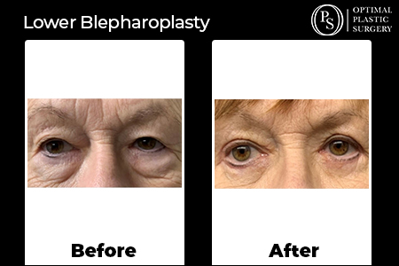 Before and after Eyelid Surgery by Optimal Plastic Surgery