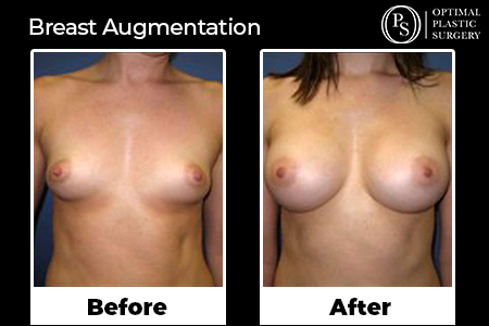 Before and After Breast Augmentation Optimal Plastic Surgery