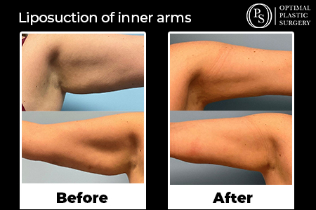 Before and after liposuction of the inner arms, surgery by Optimal Plastic Surgery