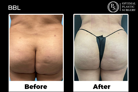 Before and After BBL Optimal Plastic Surgery